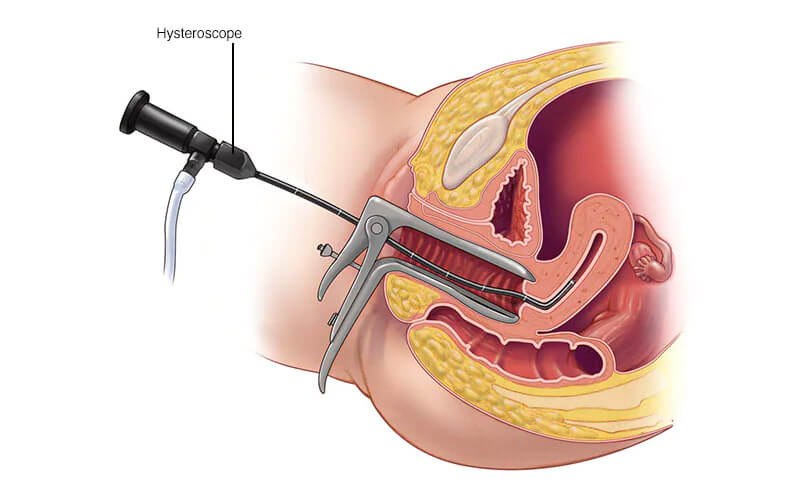 Hysteroscopy And Polyp Removal Gynecology Services Bow Mar Co Health