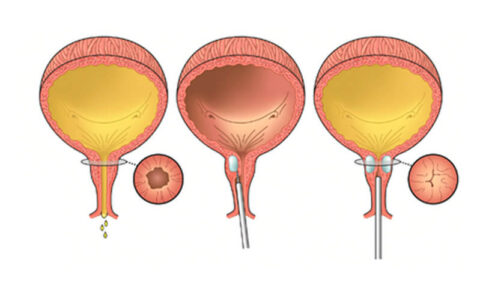 Incontinence Sling - Gynecology Services Littleton, CO | Health ...